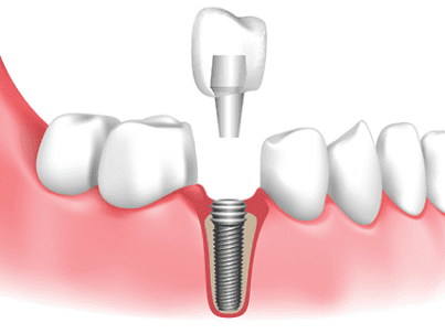 Rectangle 47 (5) Implant Dentistry